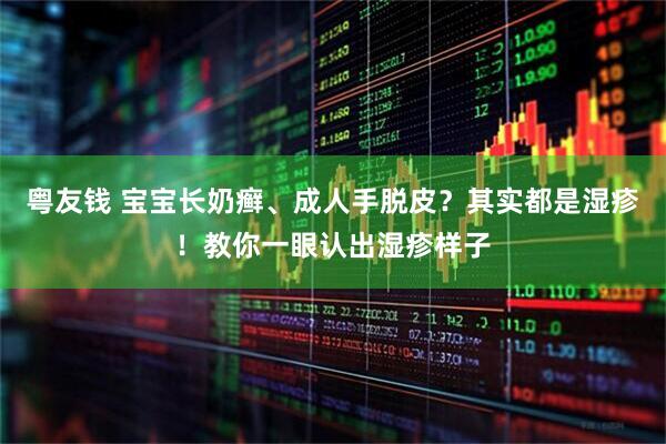 粤友钱 宝宝长奶癣、成人手脱皮？其实都是湿疹！教你一眼认出湿疹样子